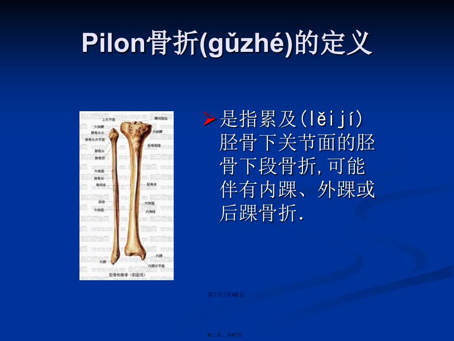 Pilon骨折的诊治现状与进展学习教案_第2页