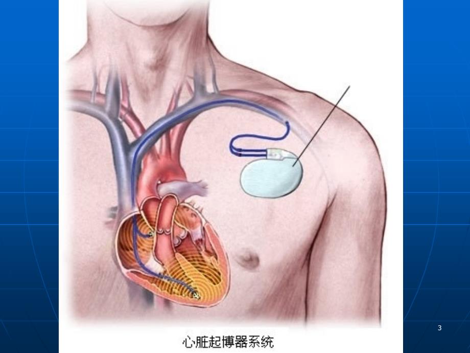 推荐精选起搏器术前术后护理_第3页