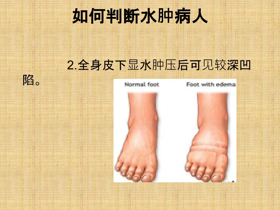 水肿病人的护理.ppt_第4页