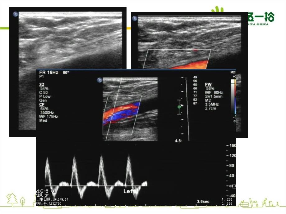 上下肢动静脉的超声检查_第4页