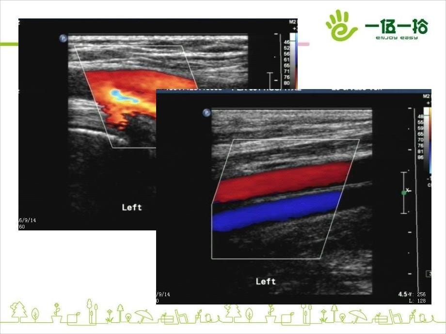 上下肢动静脉的超声检查_第5页