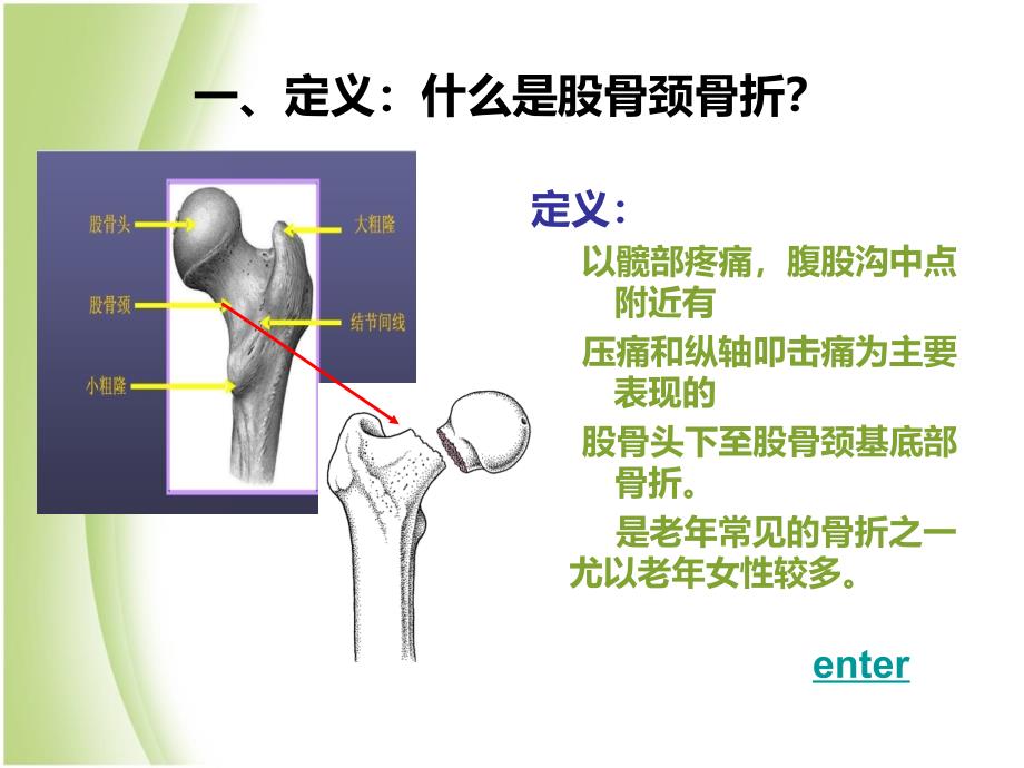 股骨颈骨折的护理演讲稿-课件(PPT演示)_第4页