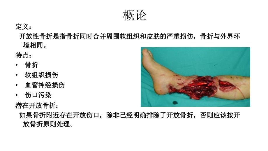 开放性骨折的治疗原则PPT1250_第3页