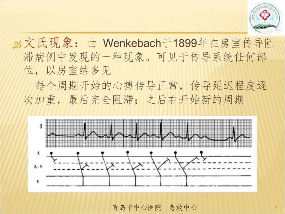 室性心动过速的心电图鉴别(课堂PPT)_第5页