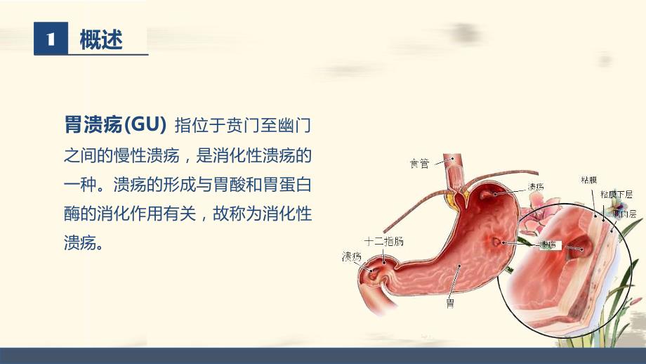 胃溃疡的业务学习_第4页