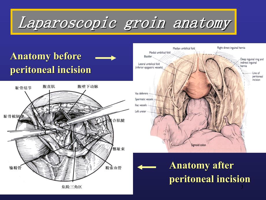 腔镜下腹股沟区的解剖PPT参考课件_第3页