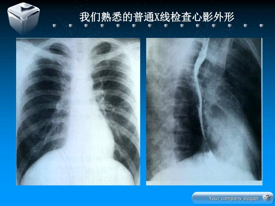 影像核医学在心血管疾病诊断中的应用_第3页