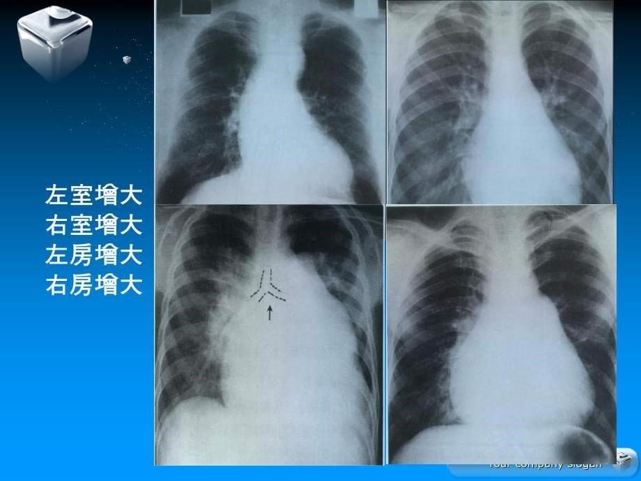 影像核医学在心血管疾病诊断中的应用_第5页