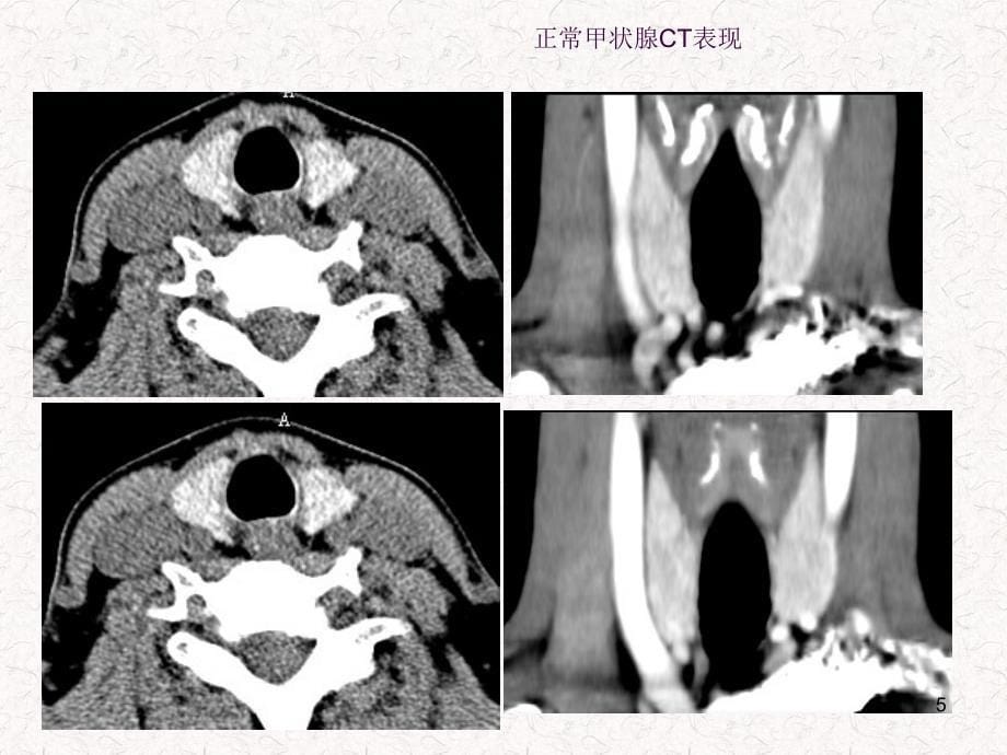 常见甲状腺疾病的CT诊断ppt课件_第5页