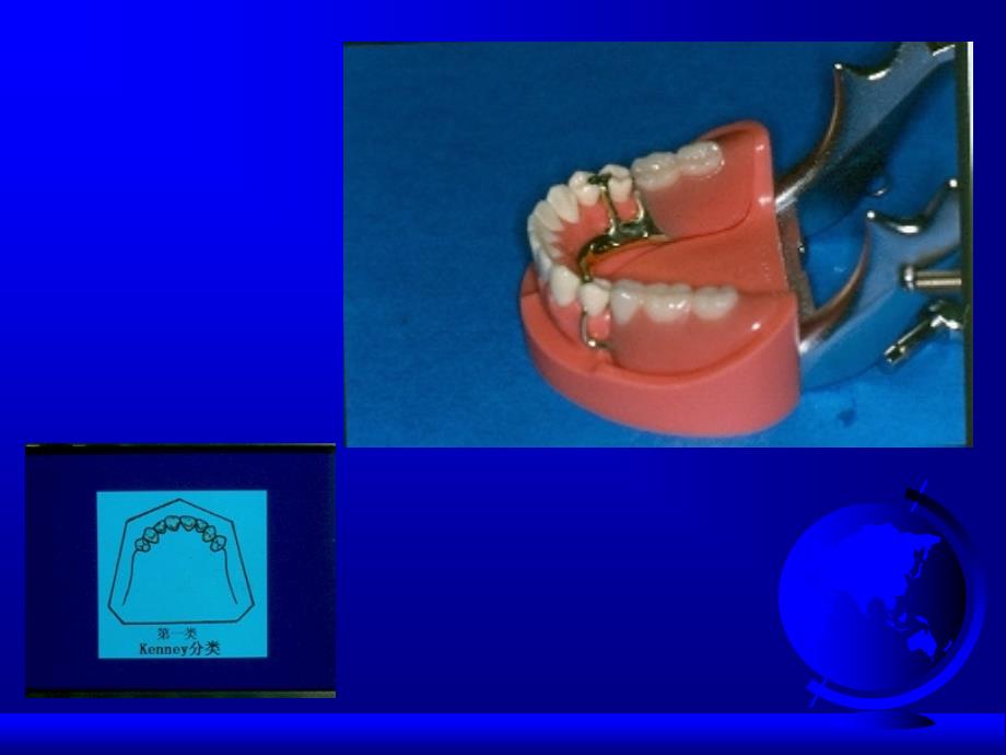 可摘局部义齿课件_第3页