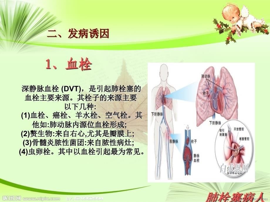 肺栓塞病人的护理_第5页