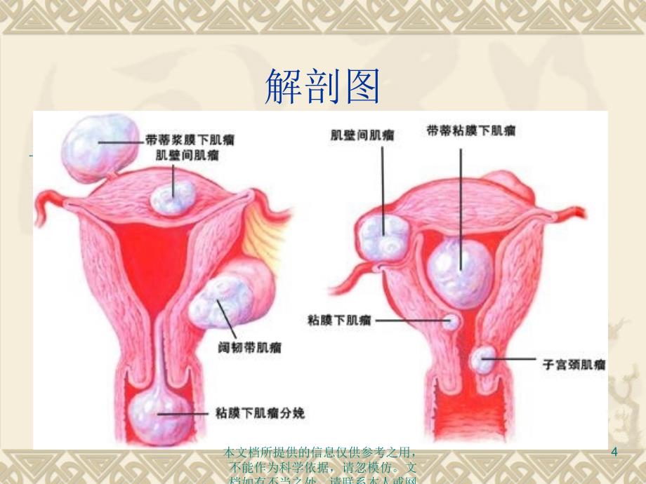 子宫肌瘤的手术配合_第4页