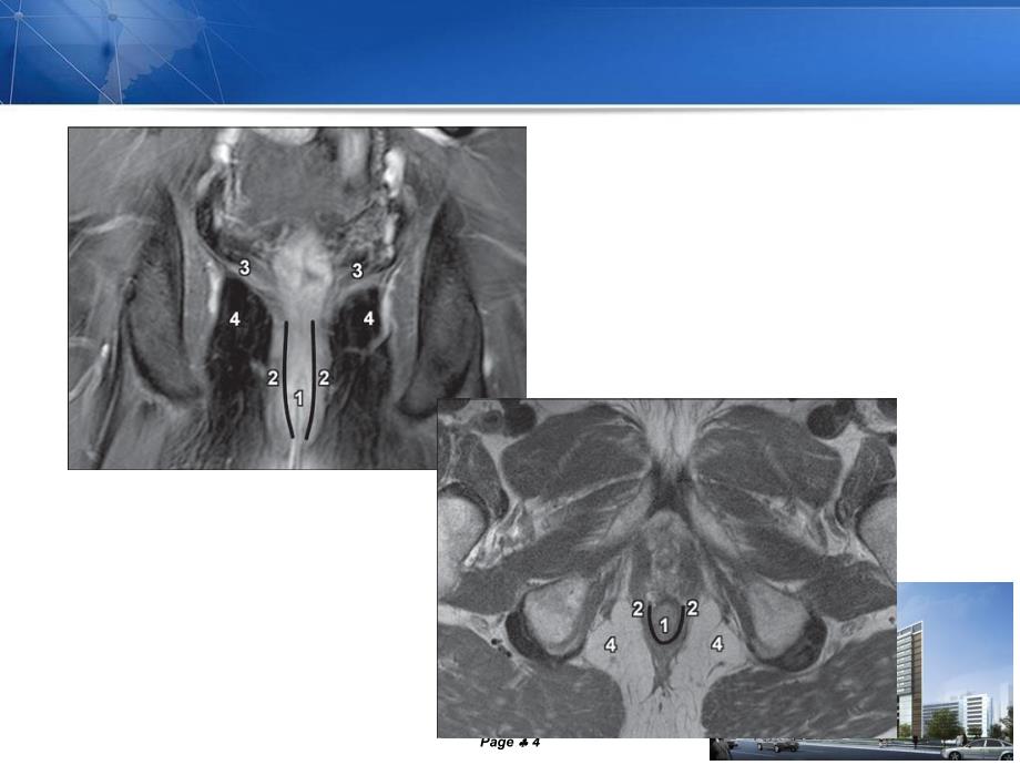 杜灏蓝MRI对各型肛瘘诊断的探讨与分析修改版.ppt_第4页