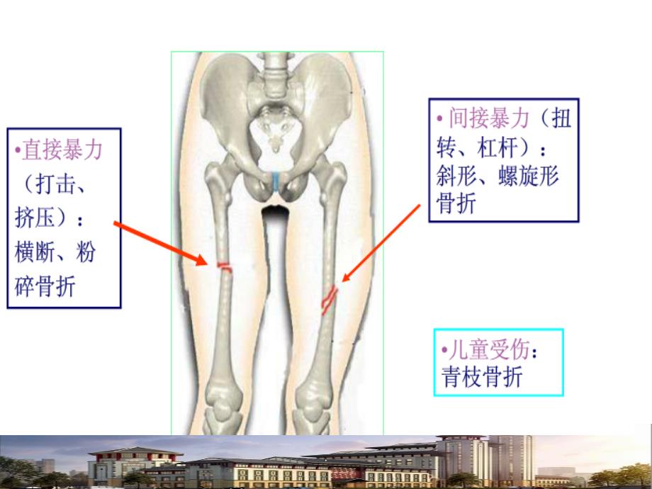 股骨干骨折骨折PPT课件_第4页