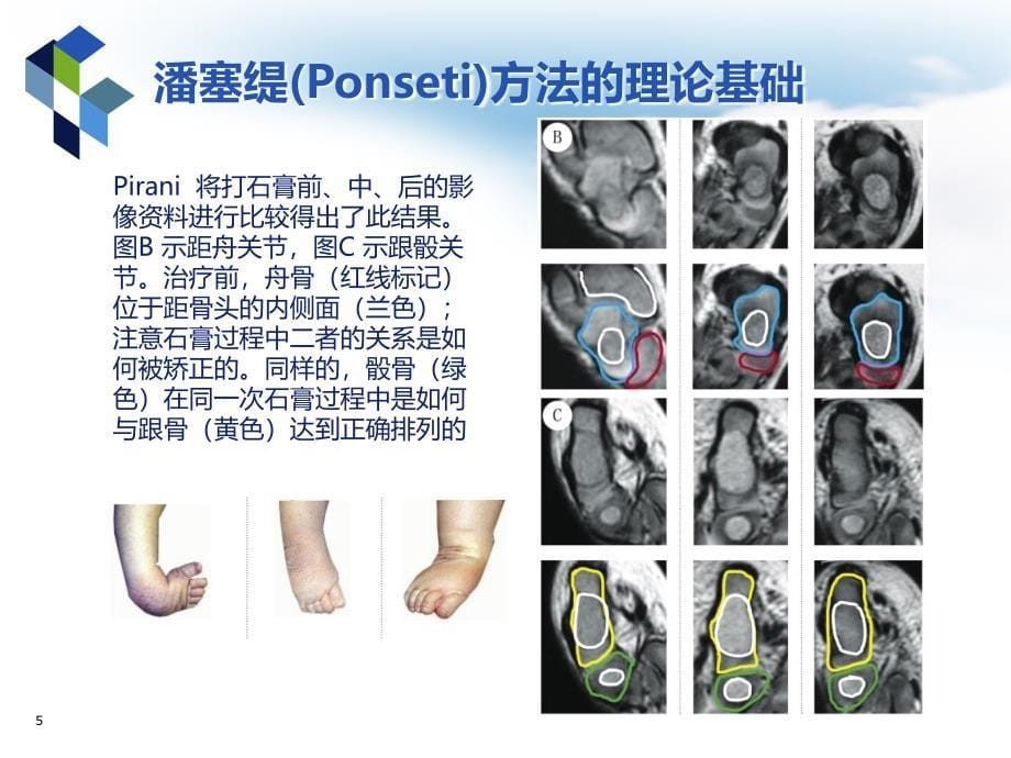 医学PPT课件马蹄内翻足潘塞缇治疗法_第5页