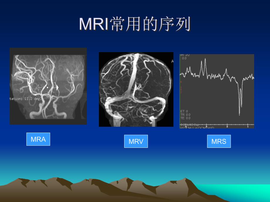 头颅MRI断层解剖.ppt_第3页