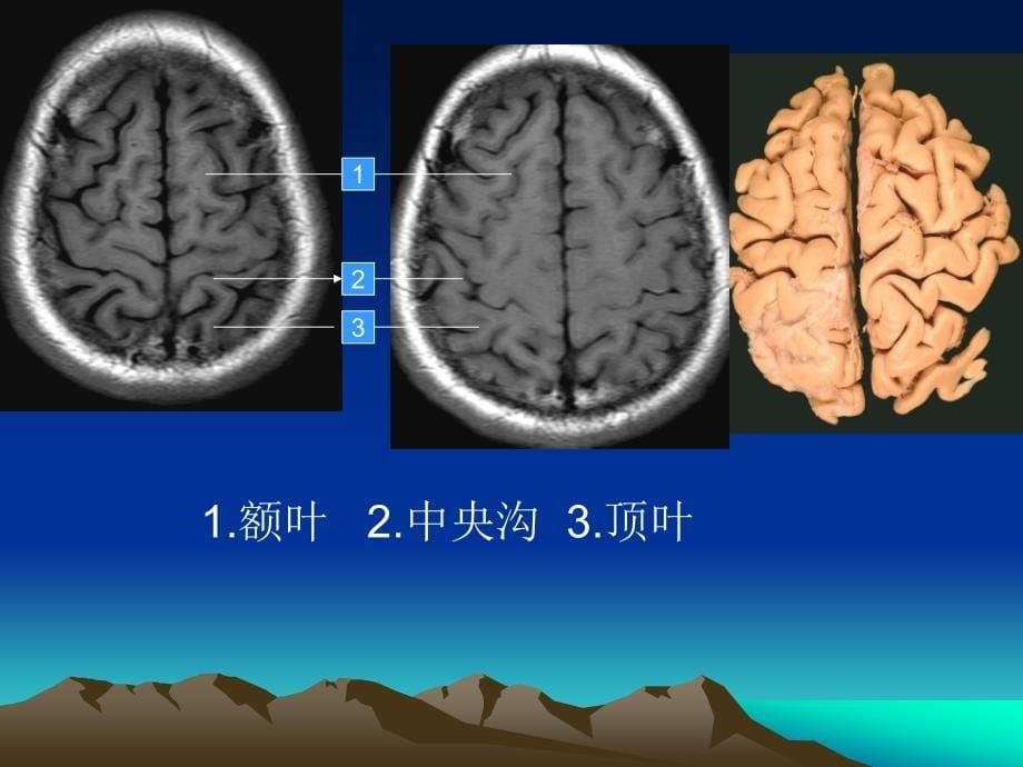 头颅MRI断层解剖.ppt_第5页