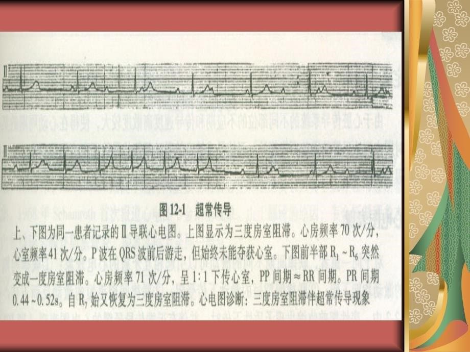 常见的心电现象课件_第5页