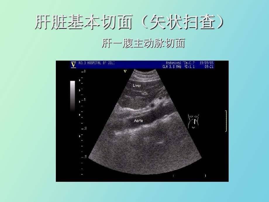 消化系统超声_第5页