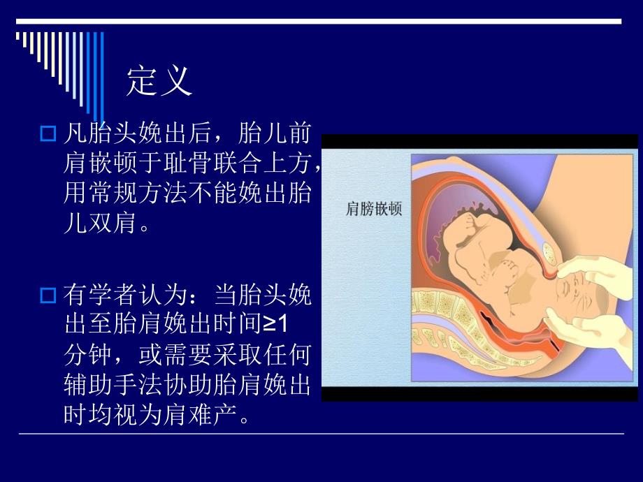 《肩难产的紧急处理》PPT课件_第3页