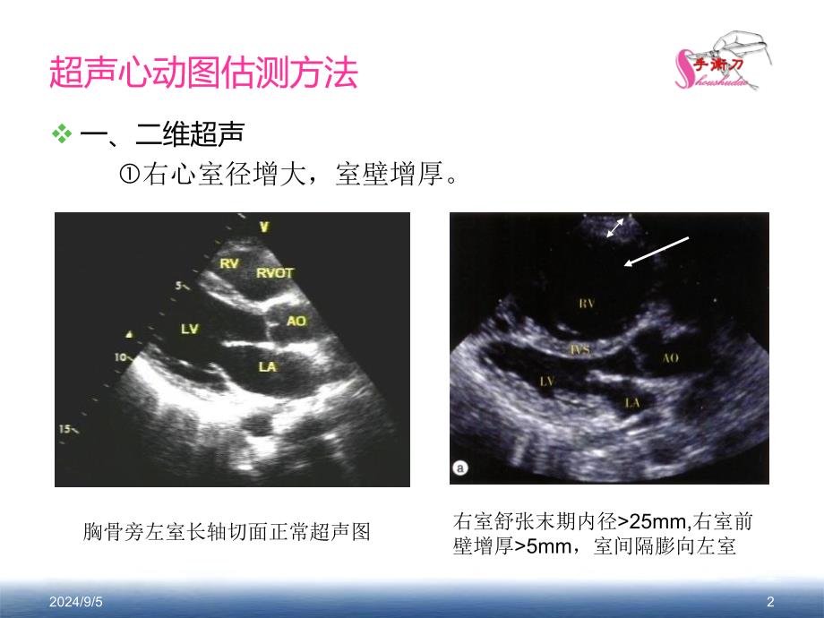 肺动脉高压的超声估测量方法课件_第2页