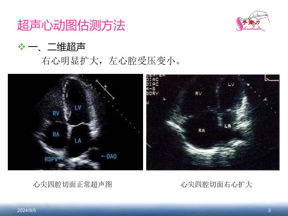 肺动脉高压的超声估测量方法课件_第3页