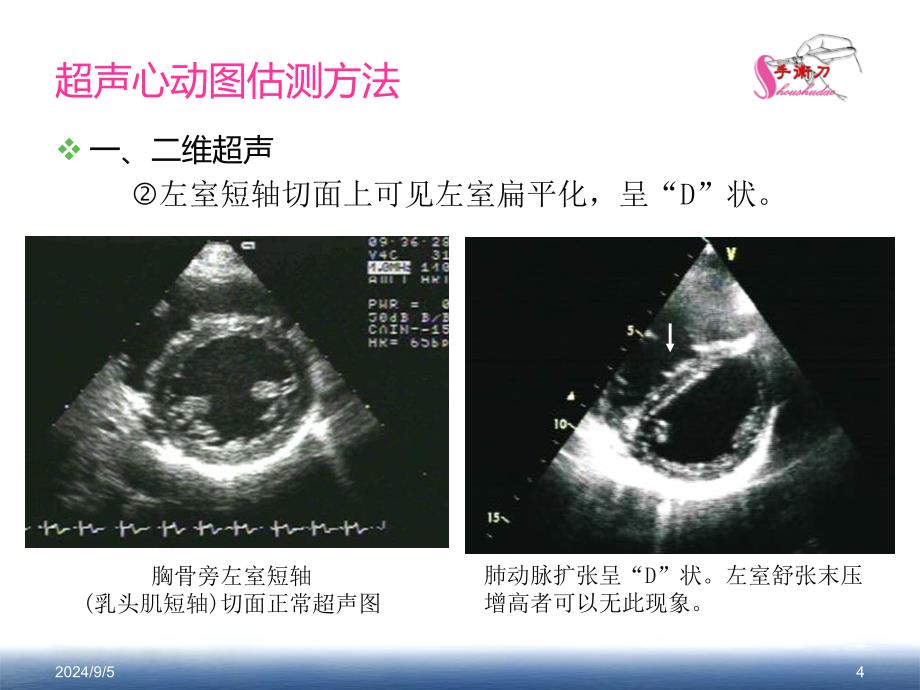 肺动脉高压的超声估测量方法课件_第4页