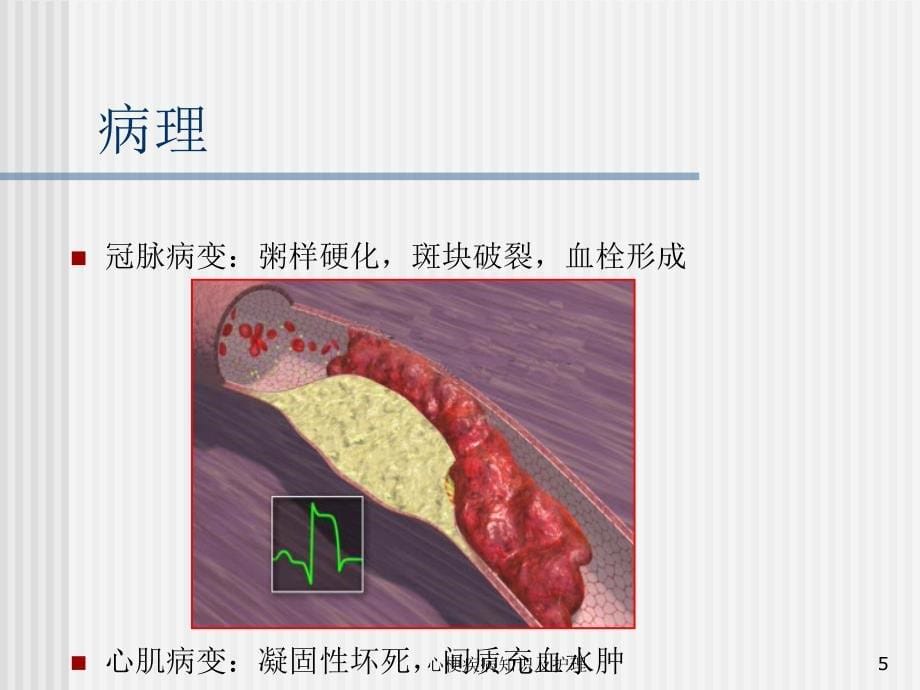 心梗疾病知识及护理课件_第5页