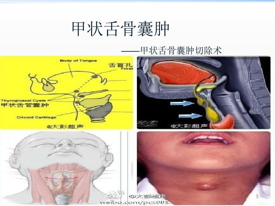 舌骨囊肿切除术ppt课件_第5页