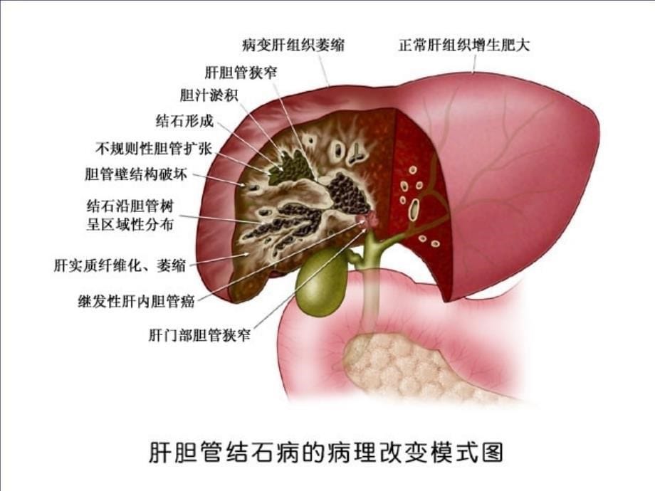 肝胆管结石病诊断治疗指南PPT精选文档_第5页