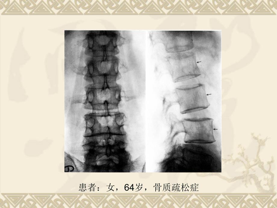 骨-质-疏-松-症分析课件_第3页