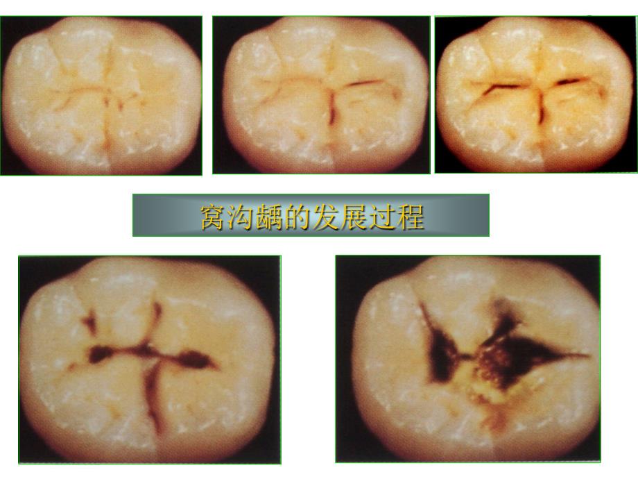 儿童口腔卫生保健PPT课件_第2页