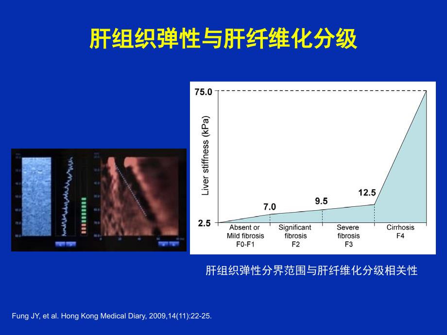 乙肝肝硬化并发症的处理课件_第3页