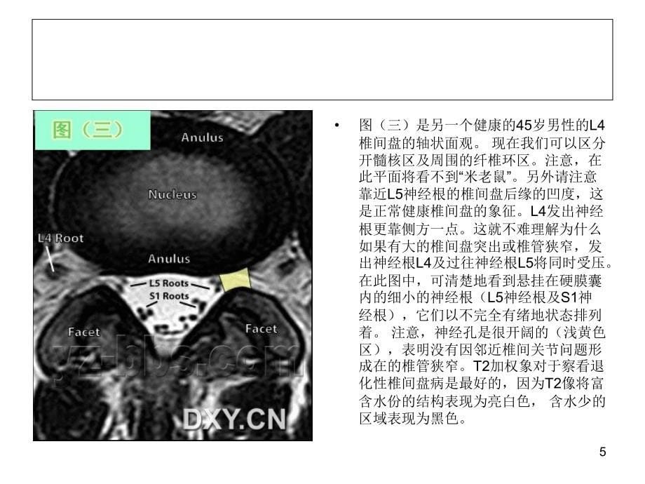 腰椎间盘突出PPT优秀课件_第5页