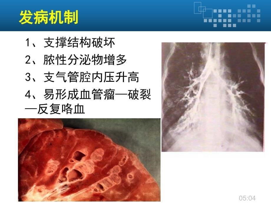 支气管扩张患者护理_第5页