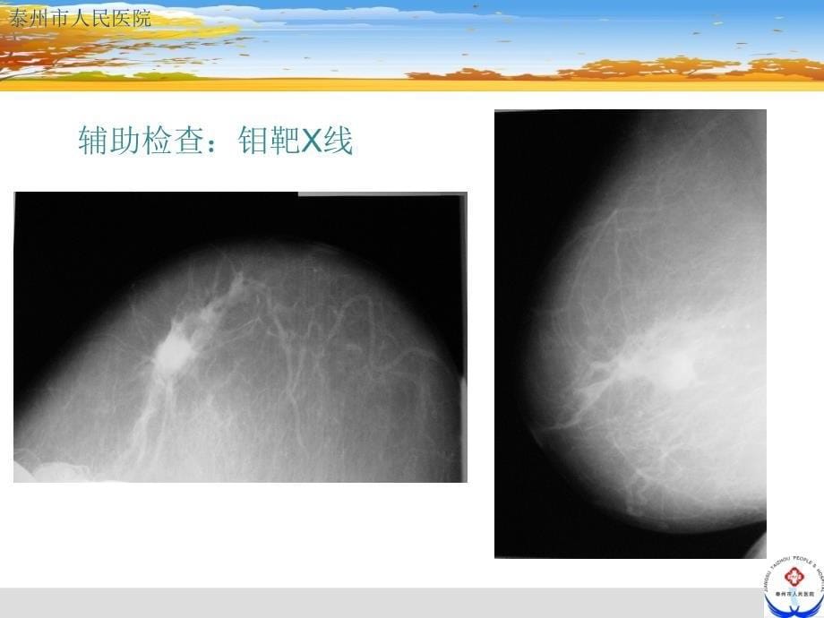 《乳腺癌教学查房》PPT课件_第5页