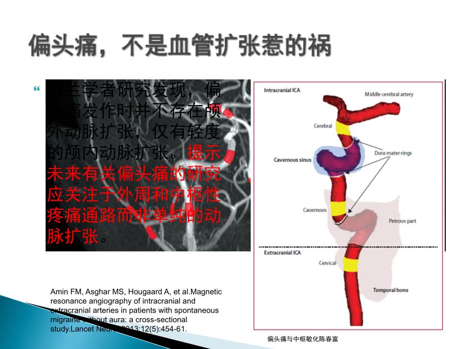 偏头痛与中枢敏化陈富课件_第2页