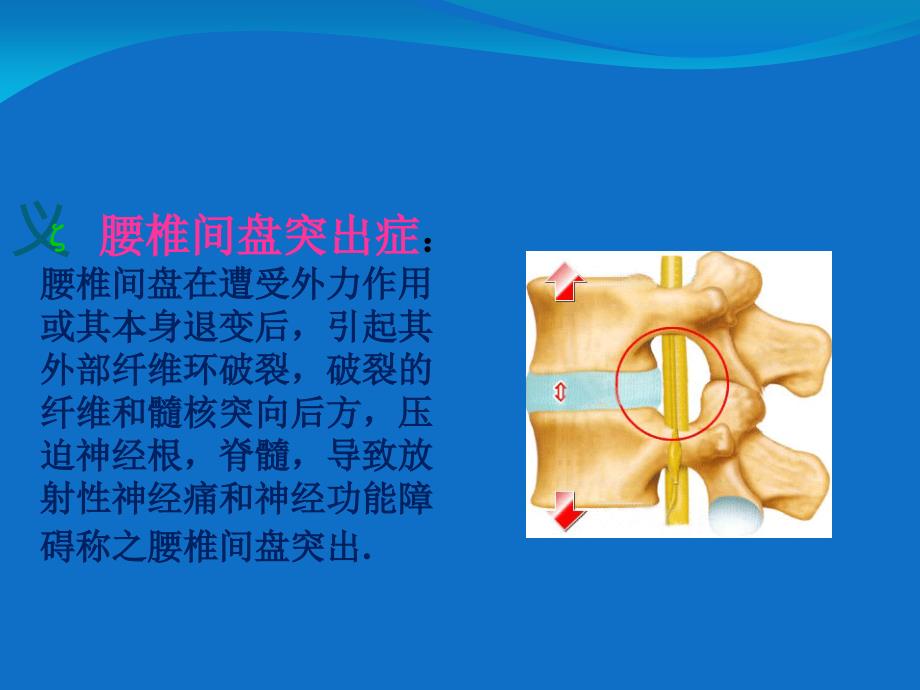 腰椎间盘突出症康复护理_第3页