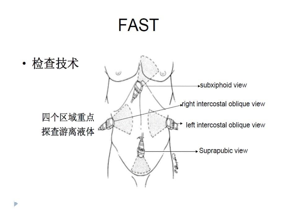 急诊床旁超声的应用详解课件_第5页