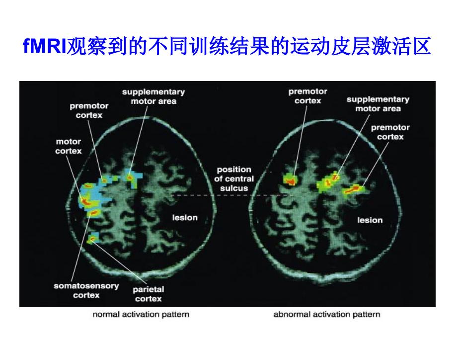 余小兰-肌电生物反馈神经康复新技术(武汉).ppt_第3页