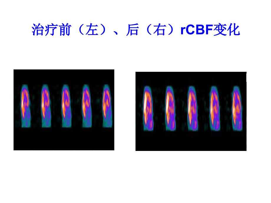 余小兰-肌电生物反馈神经康复新技术(武汉).ppt_第4页