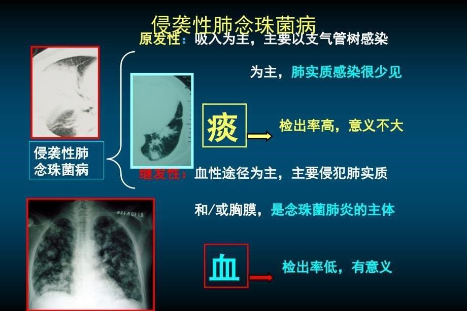 [基础学]肺部真菌感染的困惑和挑战2nanchang_第5页