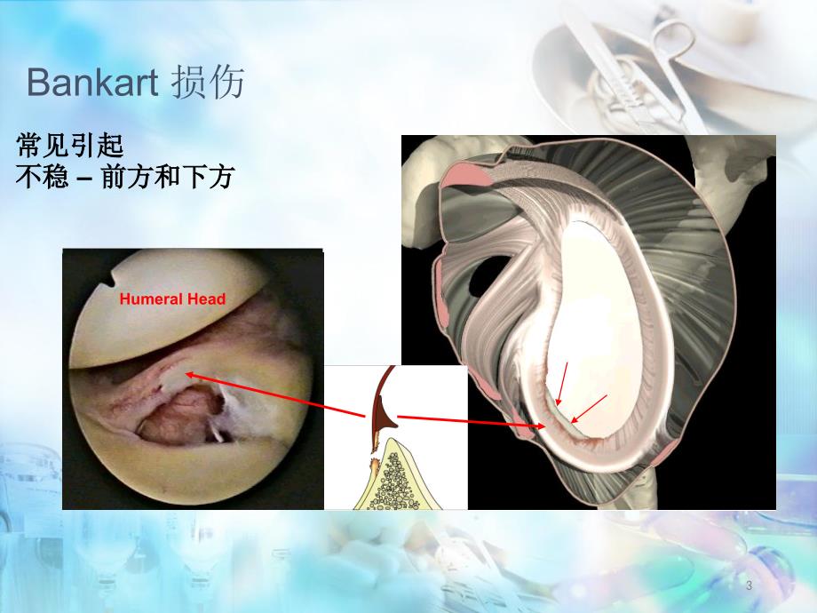 医学课件肩关节bankart损伤_第3页