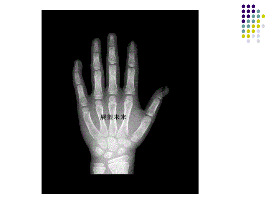 骨龄评测方法PPT课件_第4页