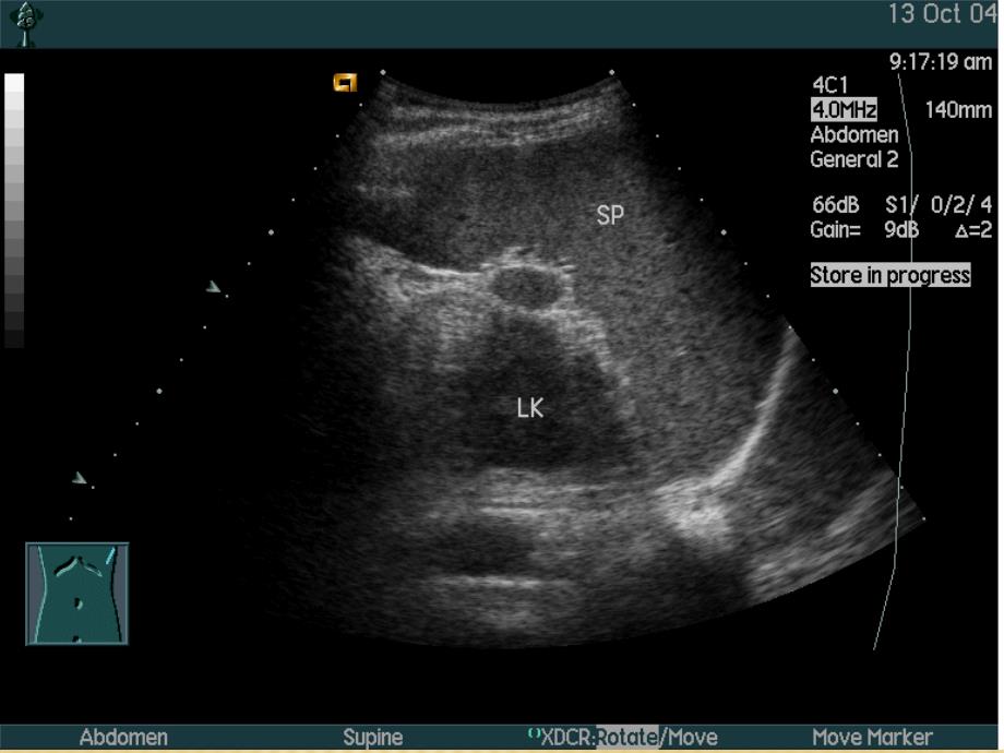 脾脏疾病的超声诊断_第4页