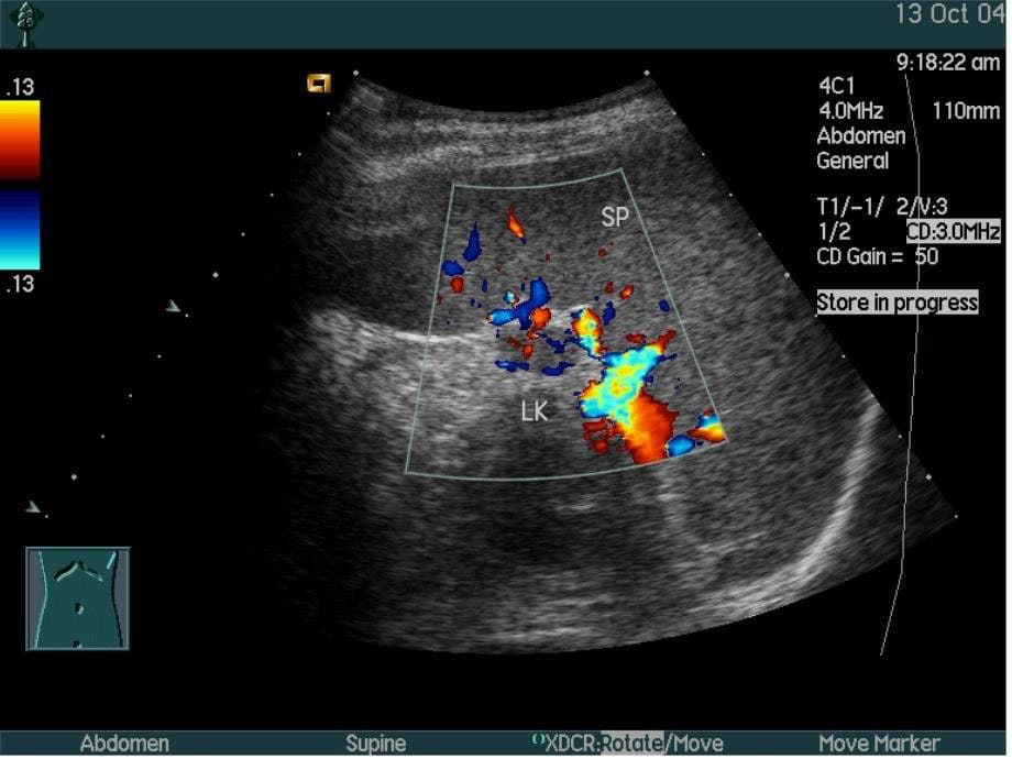 脾脏疾病的超声诊断_第5页