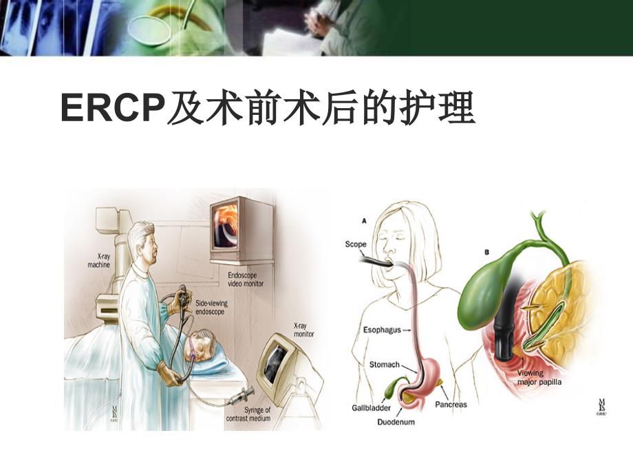 ERCP及术前术后护理课件_第1页