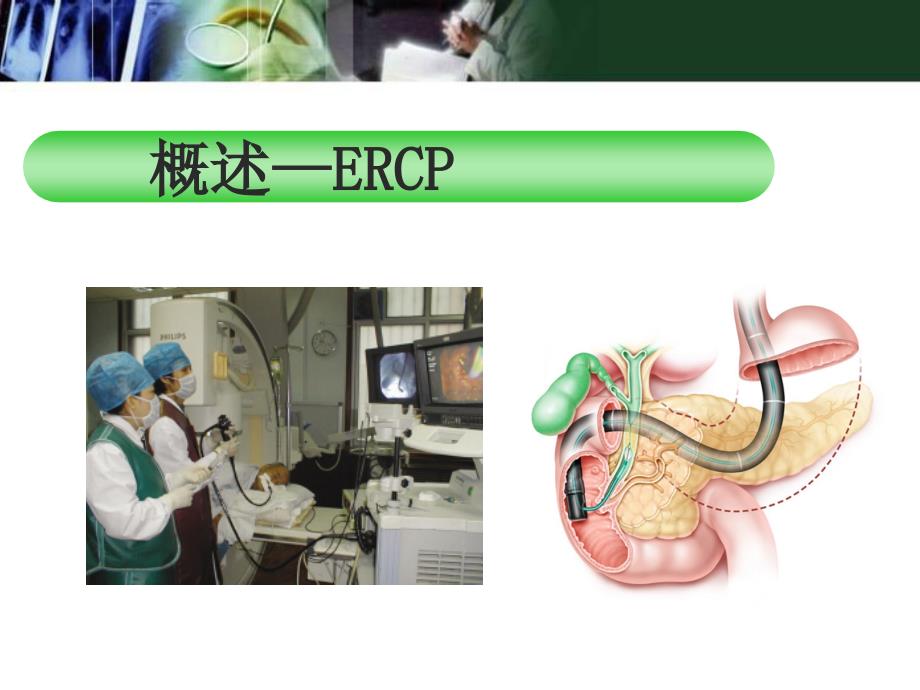 ERCP及术前术后护理课件_第4页