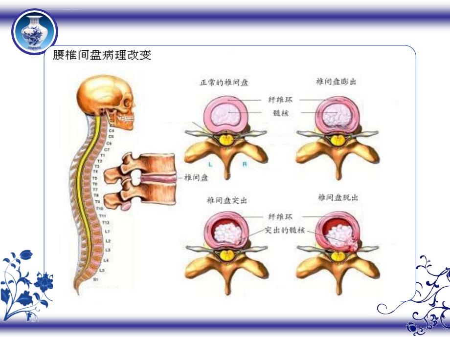 腰椎间盘突出症的护理ppt课件_第3页