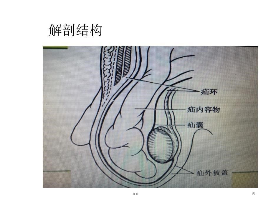 腹股沟疝的护理ppt课件_第5页